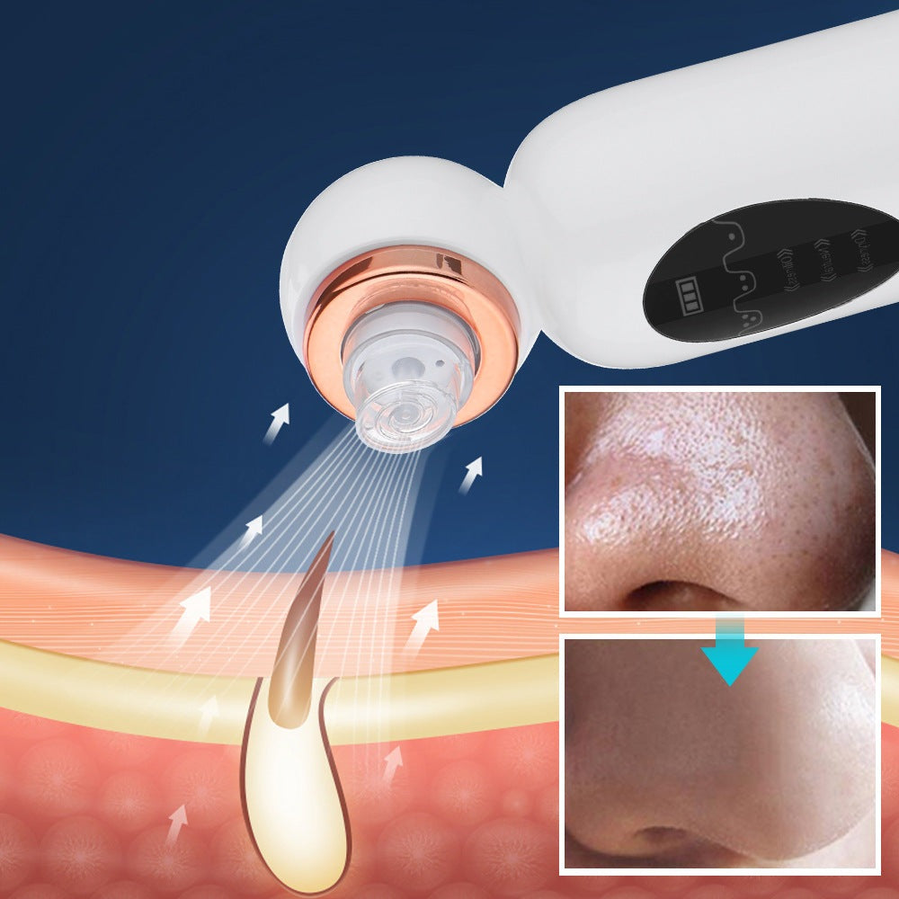 Mee-eter Remover and Hydrodermabrasion - HydraGlow-State of Style
