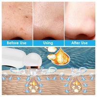Mee-eter Remover and Hydrodermabrasion - HydraGlow-State of Style