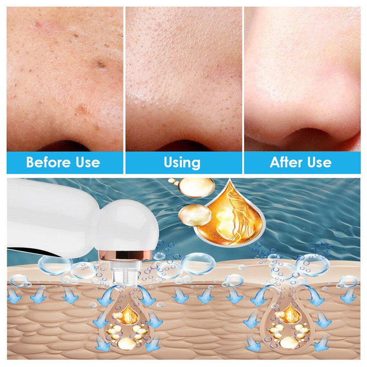 Mee-eter Remover and Hydrodermabrasion - HydraGlow-State of Style