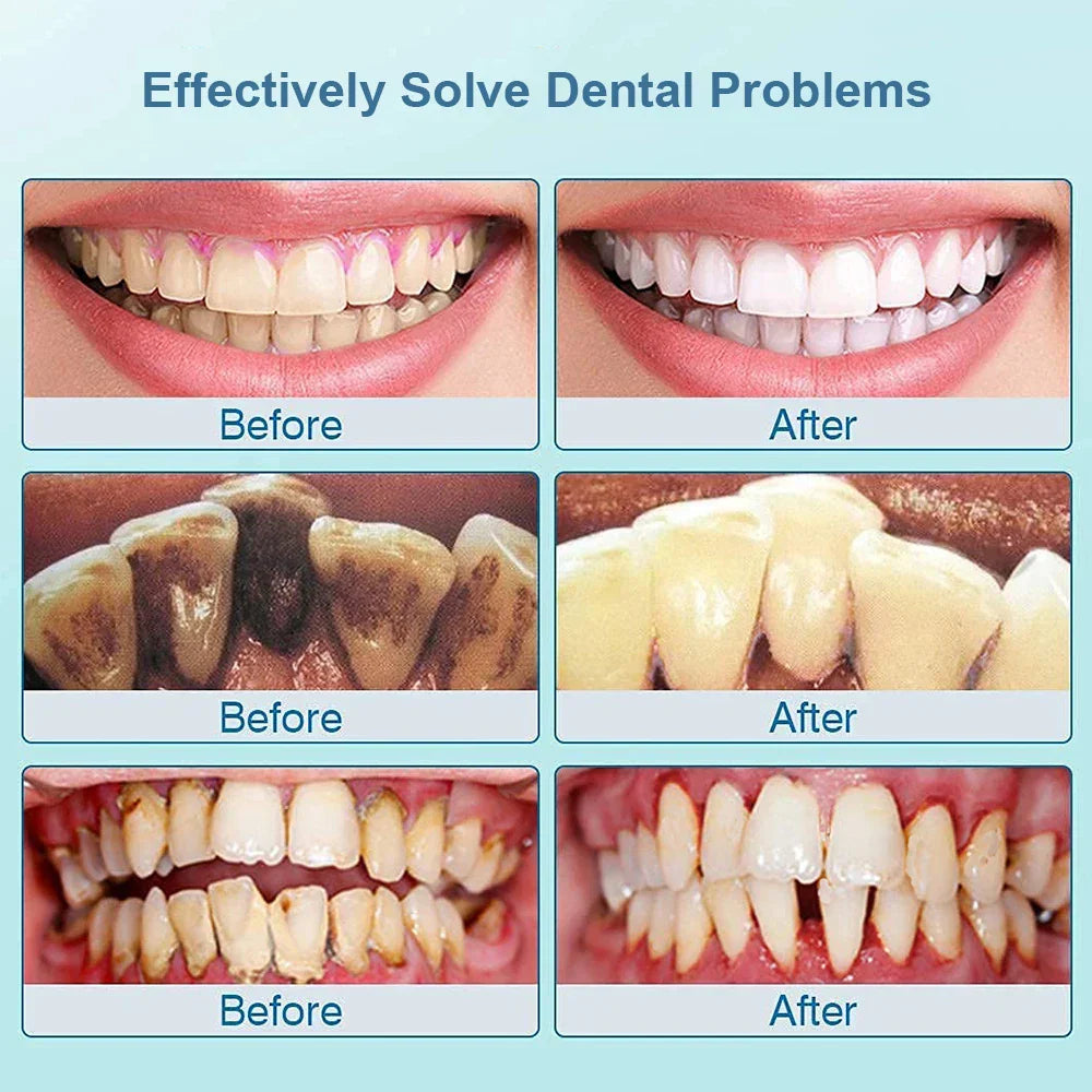 Ultrasonic Tooth Cleaner - SonicClean-White-State of Style